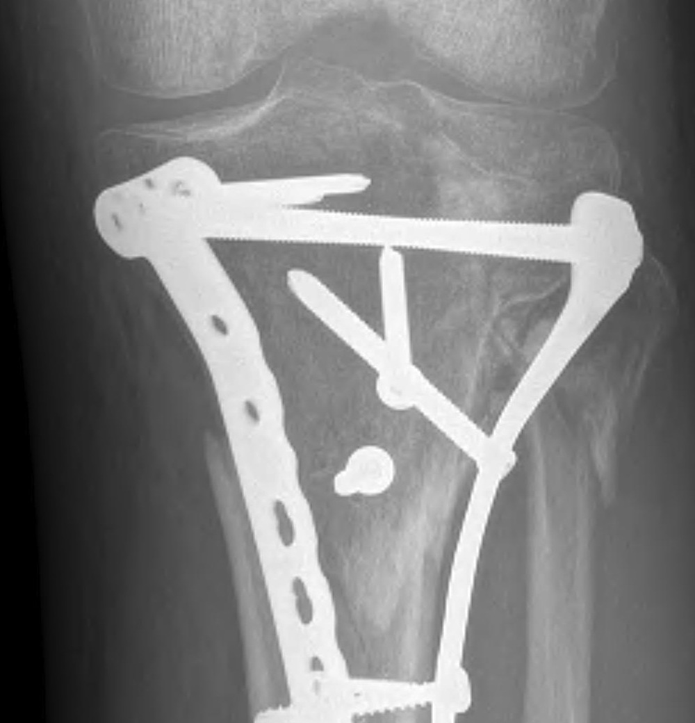 Lateral Tibial Plateau Malunion